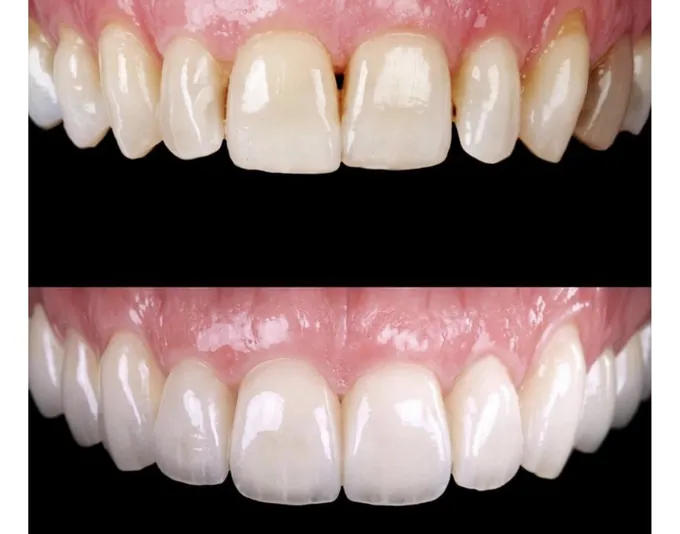 Smile before and after treatment by Dr. Fox