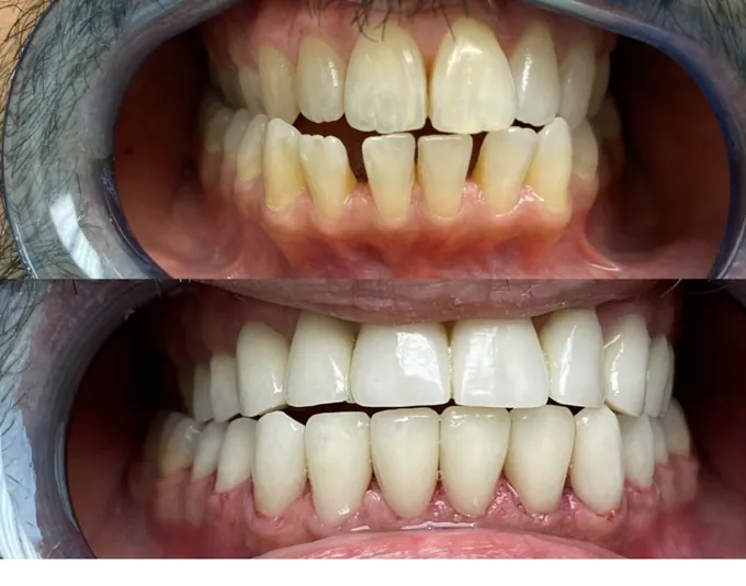 Smile before and after treatment by Dr. Fox