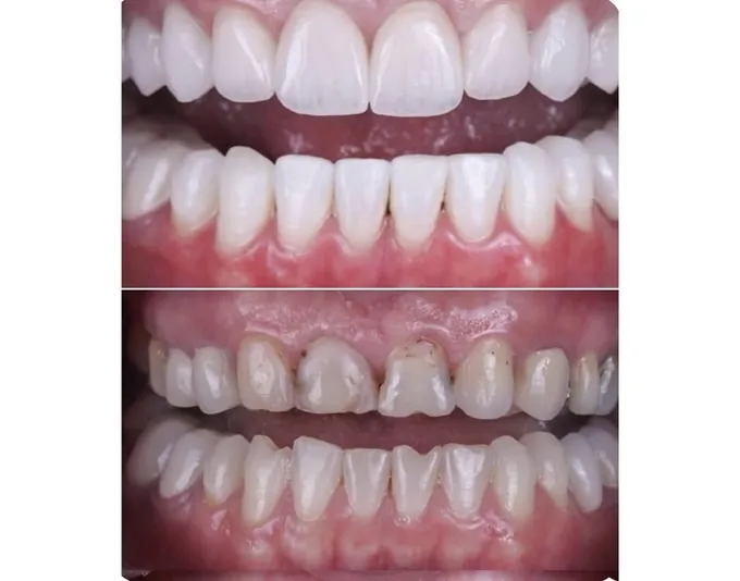 Smile before and after treatment by Dr. Fox